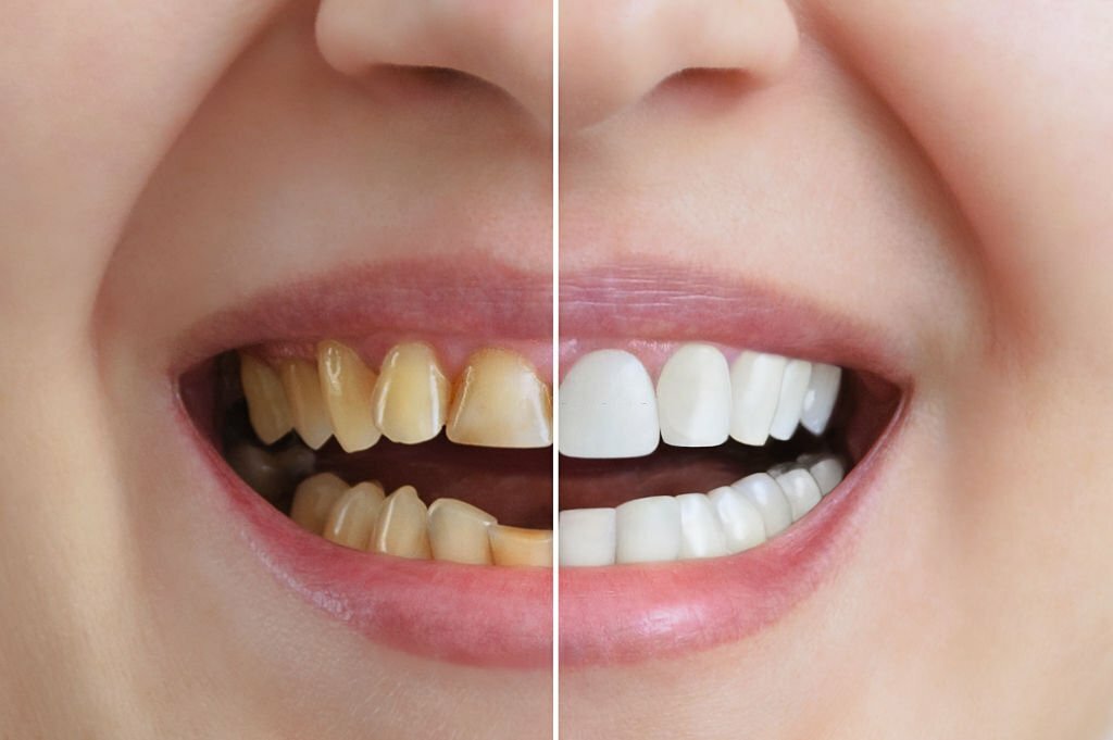 Treatment and whitening of teeth, dental crowns. Before and after. Dentistry. Close-up.