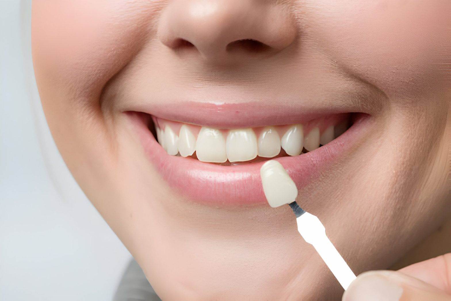 Know Everything About Dental Veneers Treatment in Kansas_FI