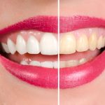 What to Expect During Your Smile Makeover Journey in Kansas City, MO