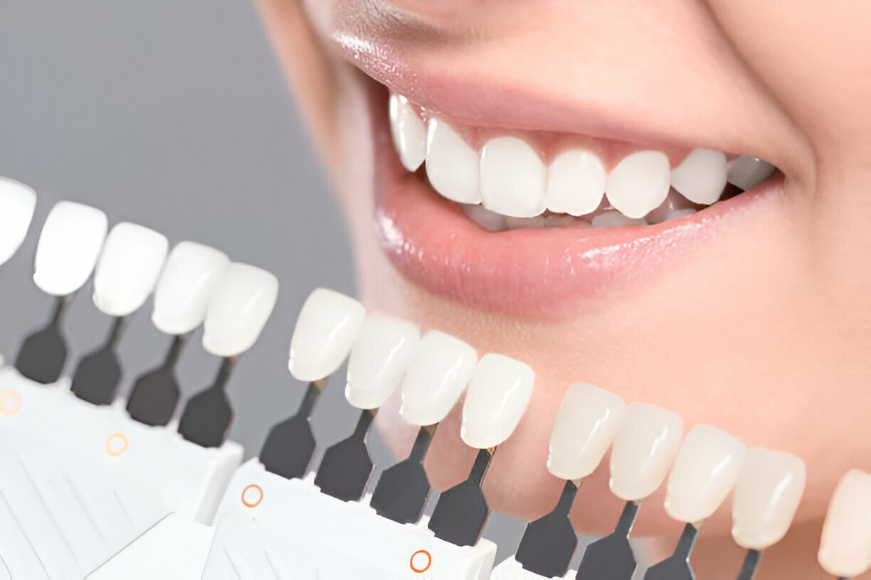 Dental Crowns in Kansas City, MO: How They Protect and Restore Your Smile_FI
